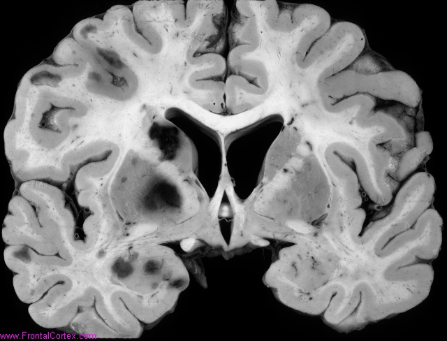 Arterial Border Zone Infarcts, unilateral